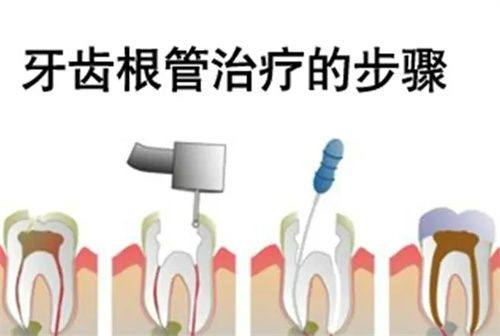 影响根管治疗后牙齿寿命的因素