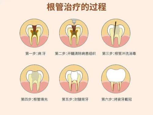延长根管治疗后牙齿寿命的建议