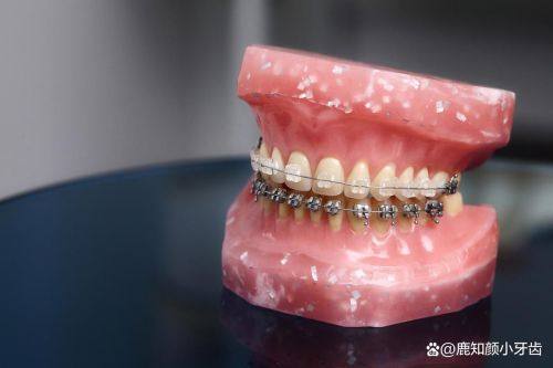 为什么尽量不要矫正牙齿？这5个真相你必须知道！