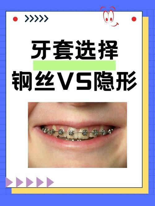 金属牙套的安心设计与优势