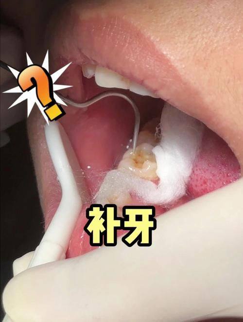 补牙的三大危害，你知道吗？不可忽视的口腔健康风险！