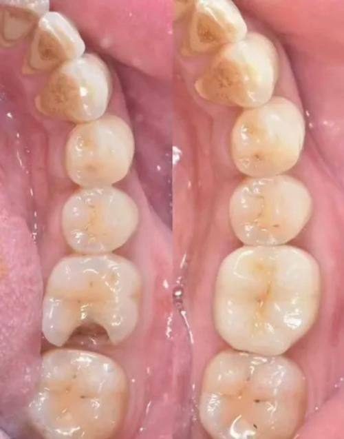龋齿程度对补牙成效的影响