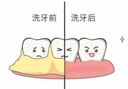 多久可以洗一次牙？揭示牙齿健康的洗牙频率！