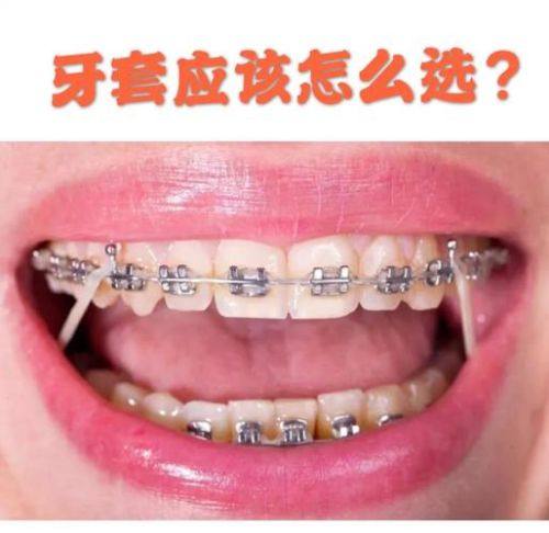 效率高舒适——自锁托槽牙套