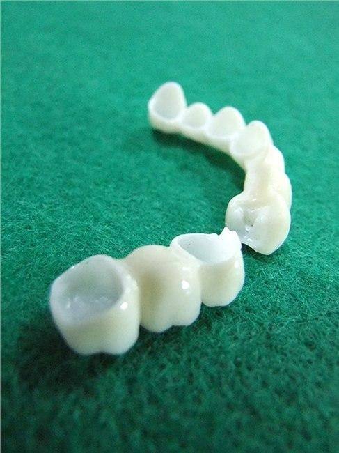 烤瓷牙能用多长时间？平均10-15年与保养指南