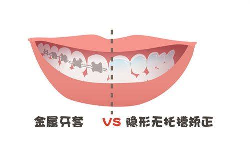 影响牙齿矫正费用的3大因素