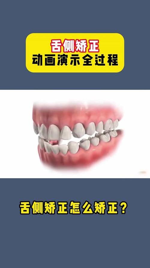 10-15岁矫正牙齿费用多少？3大因素决定价格